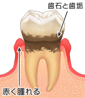 歯周炎(軽度)