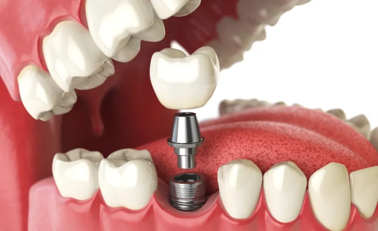 Dental Implant Treatment