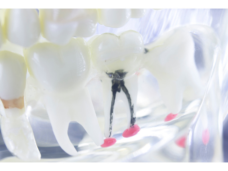 歯内療法・根管治療についてのよくある質問