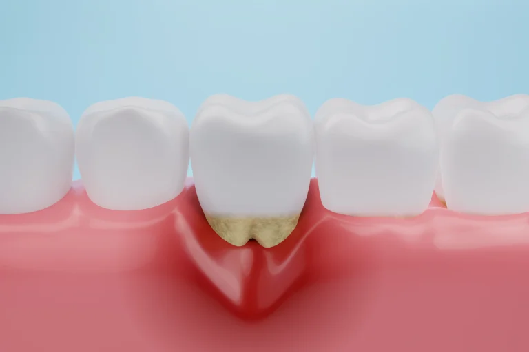 Periodontal Disease Treatment