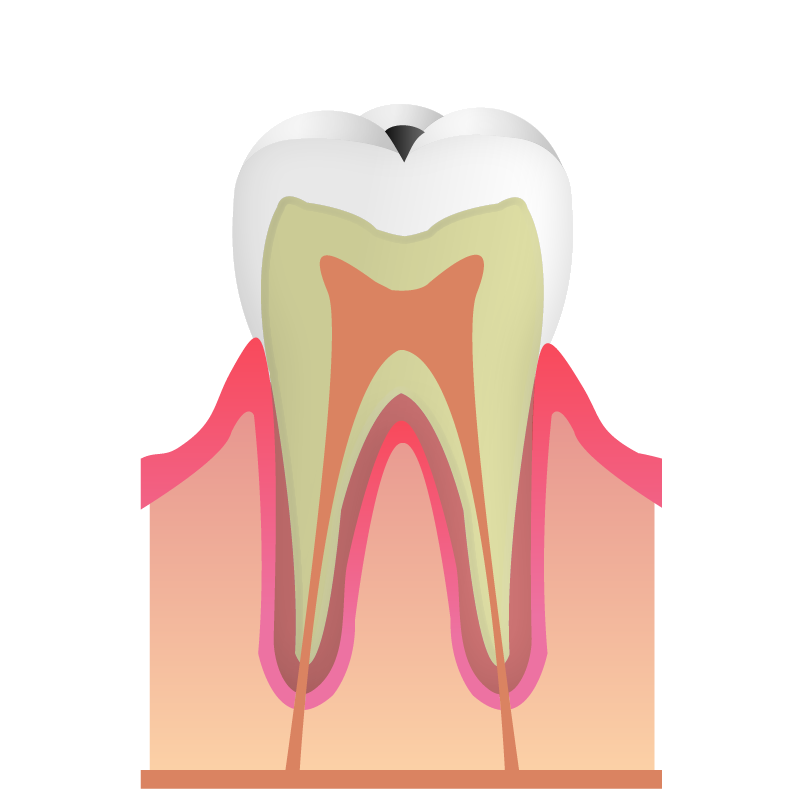 C1エナメル質の虫歯