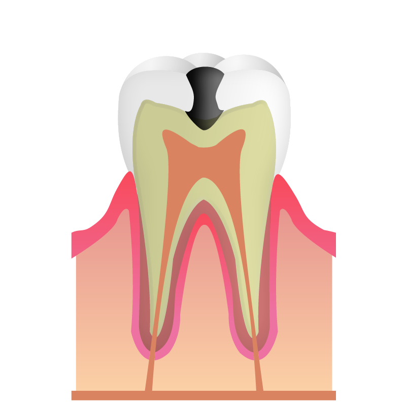 C2象牙質の虫歯