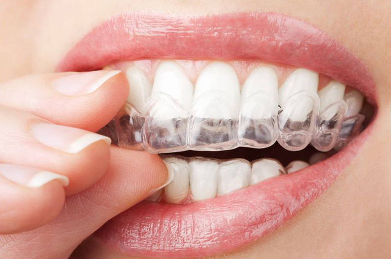 インビザラインを使用した矯正歯科治療とは？