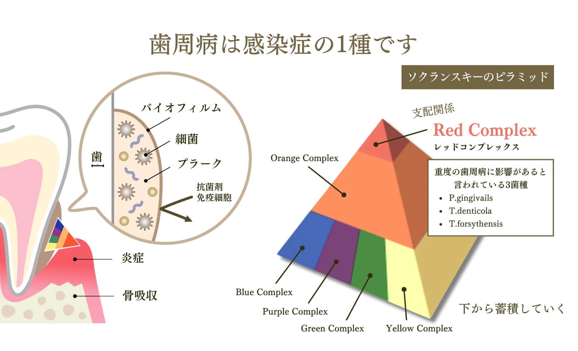 歯周病は感染症の1種です