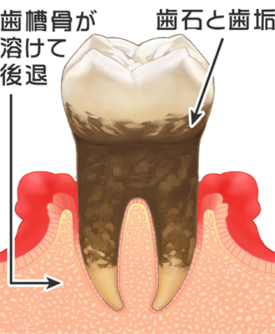歯周炎(中度)