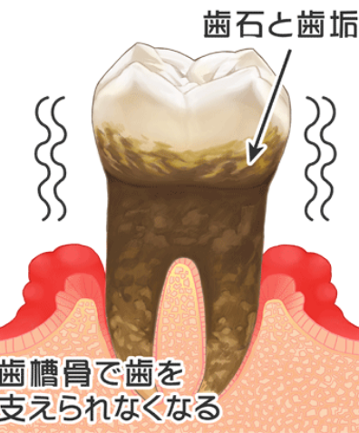 歯周炎(重度)