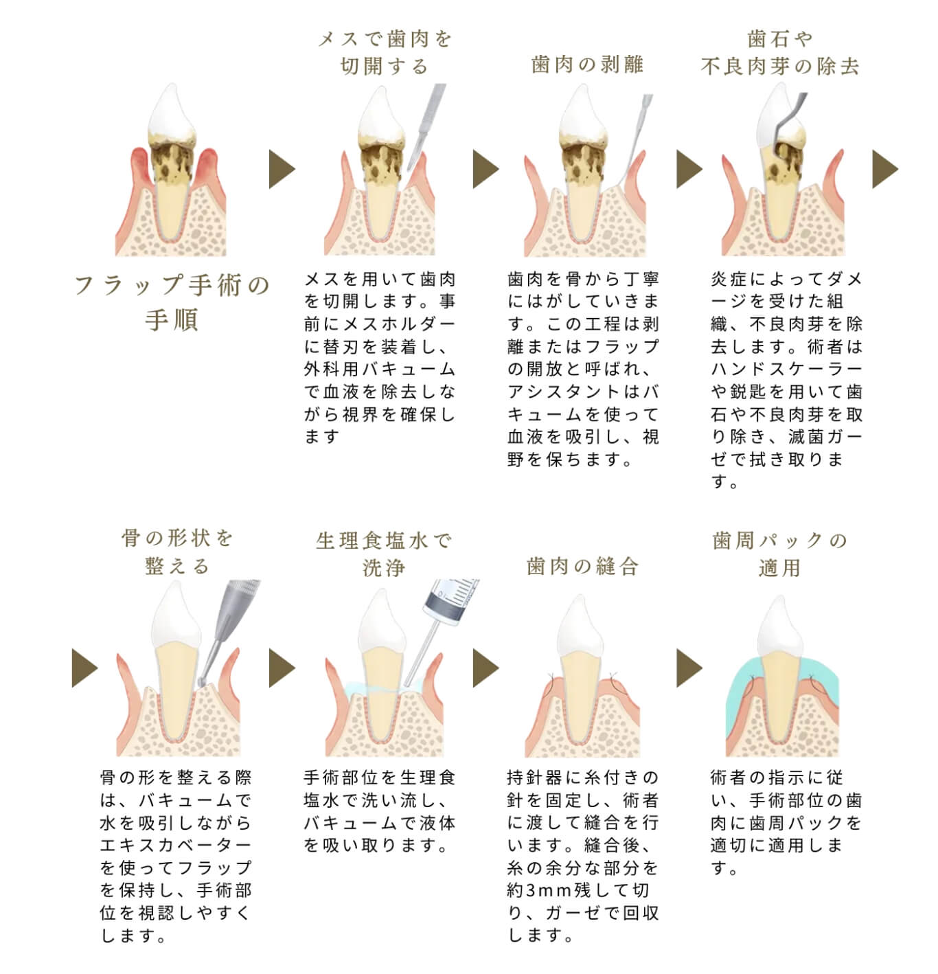 フラップ手術とは